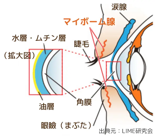 マイボーム腺機能不全の図解