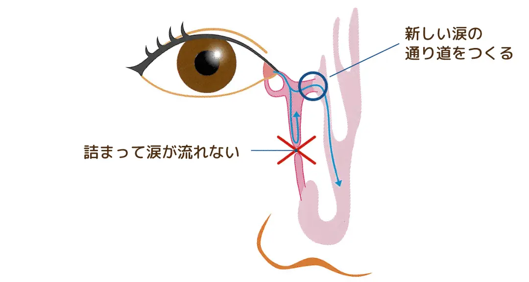 涙嚢鼻腔吻合術イメージ
