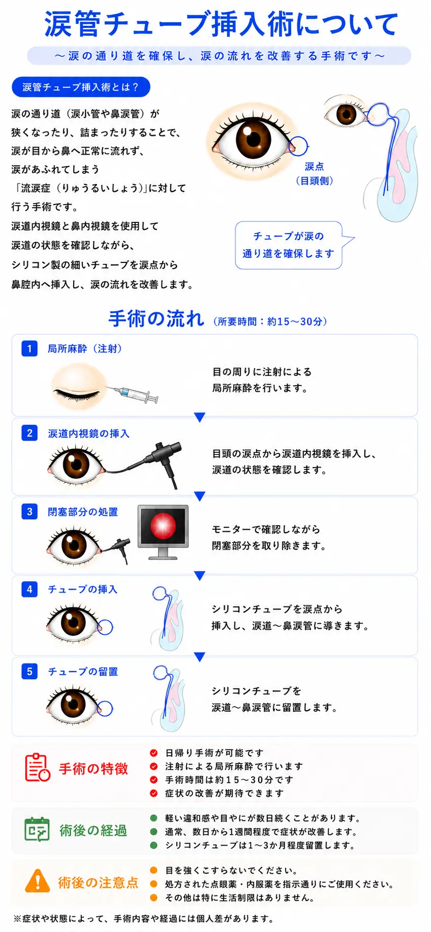 涙管チューブ挿入術について