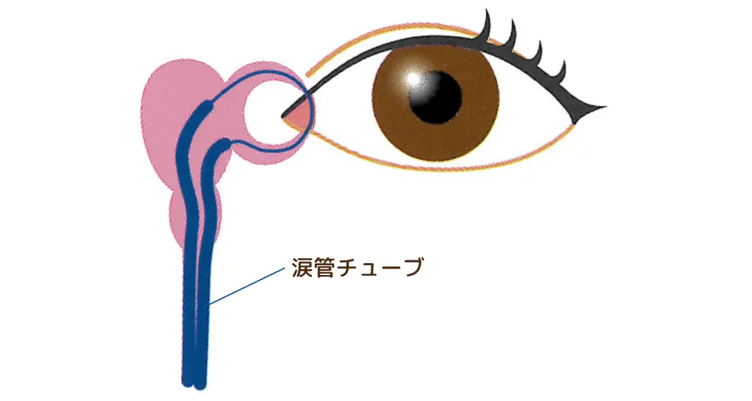 涙管チューブ挿入術イメージ