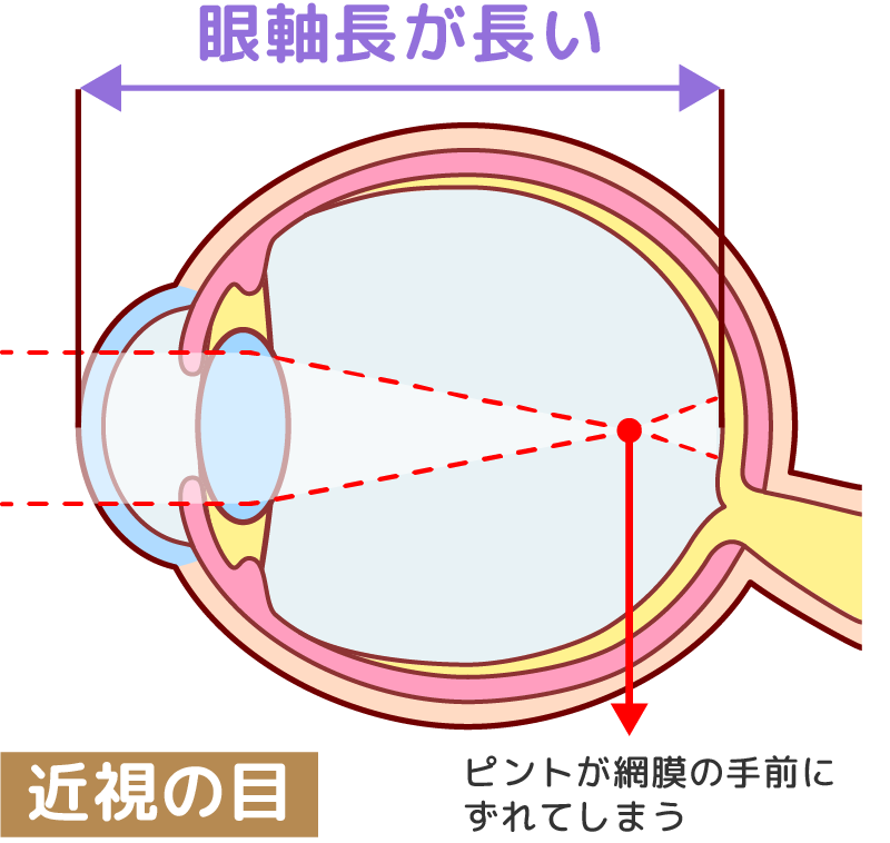 近視の眼イメージ