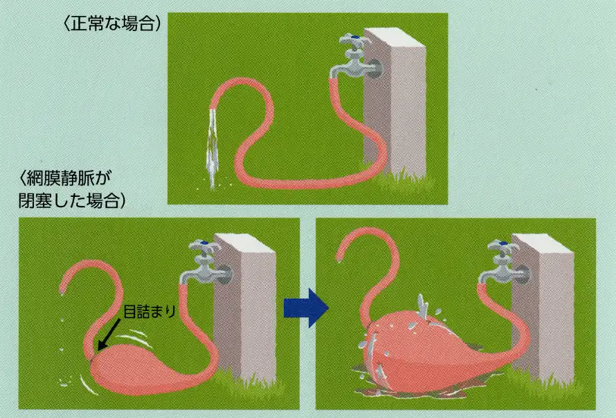 正常な場合と網膜静脈が閉塞した場合のイメージ