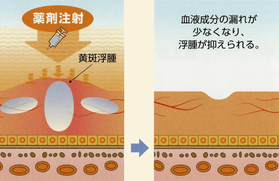 黄斑浮腫に硝子体注射を行うと血液成分の漏れが少なくなり、浮腫が抑えられます。